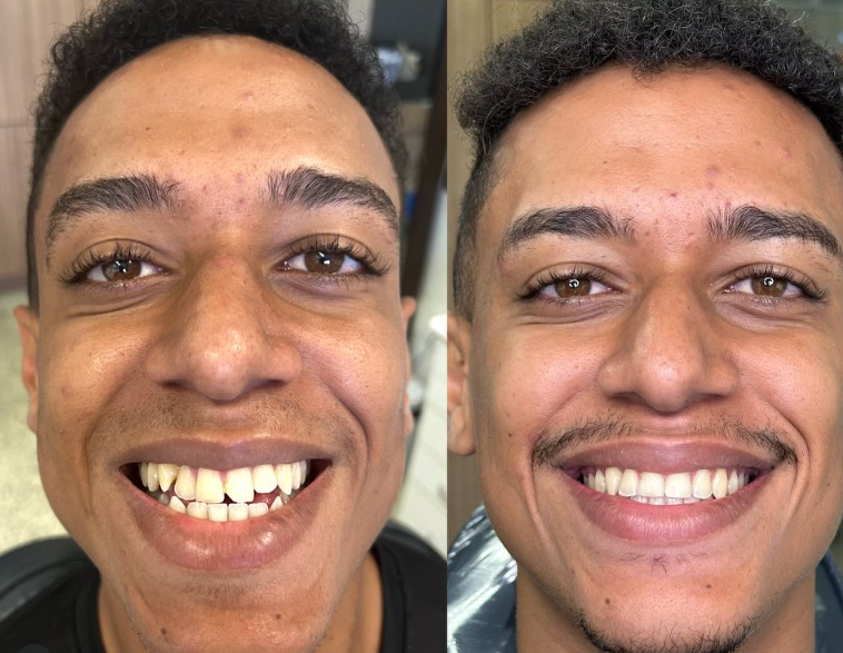 Antes e depois — procedimento 8